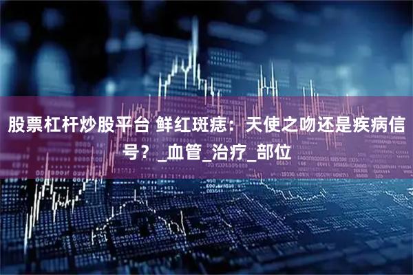 股票杠杆炒股平台 鲜红斑痣：天使之吻还是疾病信号？_血管_治疗_部位